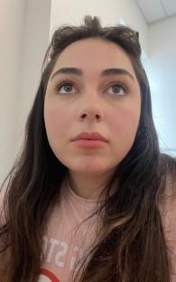 Woman's face before and after weight loss.