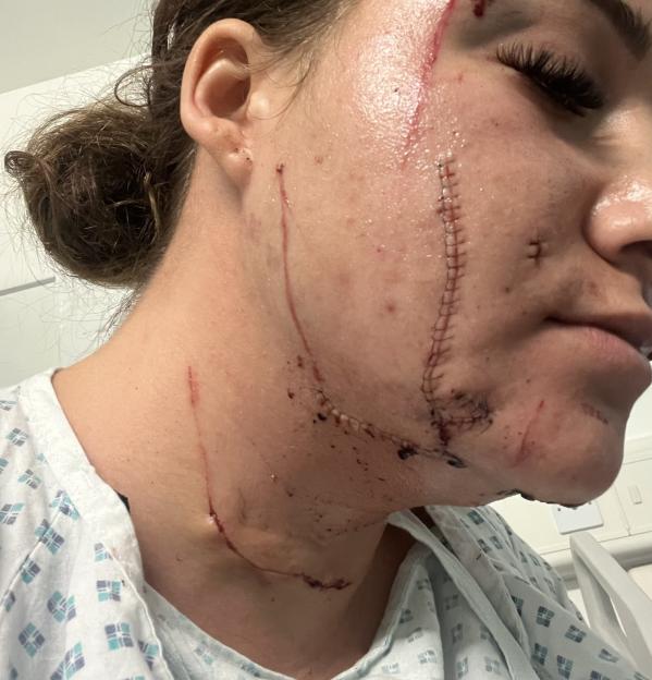 Rosie's injuries after the attack. A woman caught the moment her ex slashed her throat on her doorbell camera after he hid in the bushes and waited for her to leave for work. Rosie Niessen, 28, left for work as a prison officer when her ex-partner, Simon Scrimshaw, then 50, came up behind wielding a Stanley knife. He slashed her throat and hacked her face, neck and hands as she fought back. Luckily Rosie's dad, Roberto Niessen, 55, a doorman, heard her screams and came to her rescue but suffered a gash on his leg.