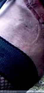 Close-up of a scar on a leg.