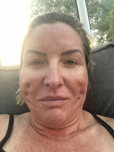 Leigh Cobb with gaping holes in her face after a botched 'lunchtime threadlift'.