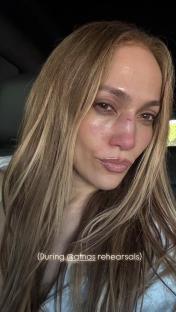 Jennifer Lopez with a facial injury during award show rehearsals.