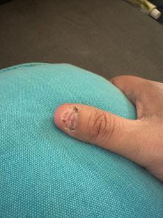 Close-up of a thumb with a damaged nail.