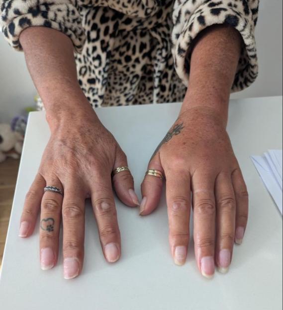 Close up of a person's hands covered in bed bug bites.