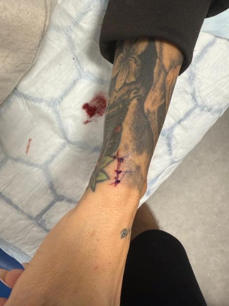 Close-up of a hand with stitches and blood, showing an injury.