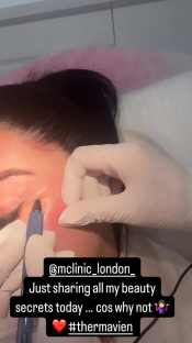 Close-up of a person's face receiving a beauty treatment.