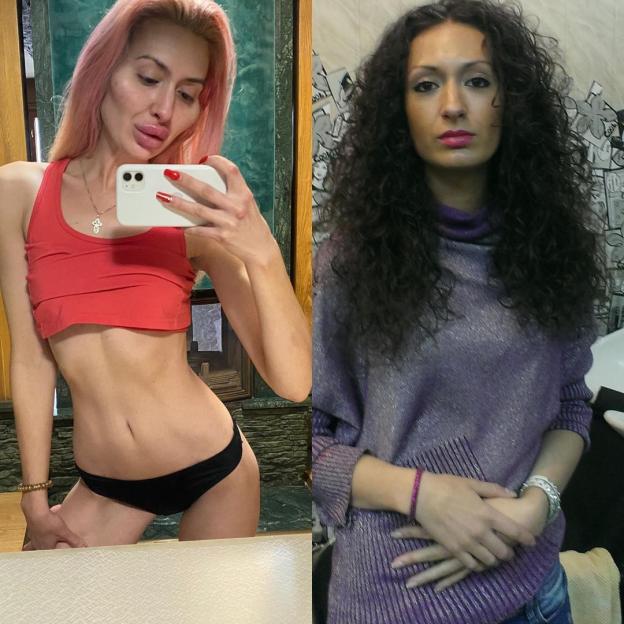 Collage of two images of the same woman, one with large cheek fillers and one without.