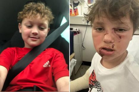 Boy, 8, mauled in the FACE by vicious ‘Staffy’ who pounced on him in street leaving horror injuries