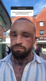 Man with head swelling after hair transplant.