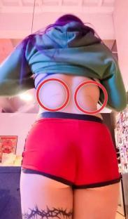 Person's back with scars circled.