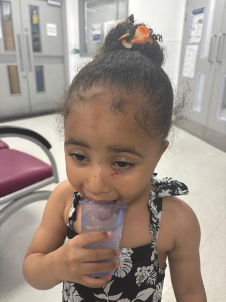 Maliea-Kay with scratches and bruising on her face after being attacked by a border collie.