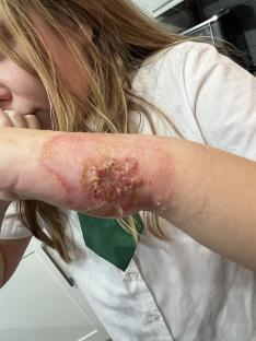 Close-up of a girl's arm with a severe burn.