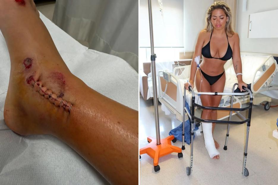 Bianca Gascoigne rushed to A&E after horror holiday accident as Love Island star shares snaps from hospital room