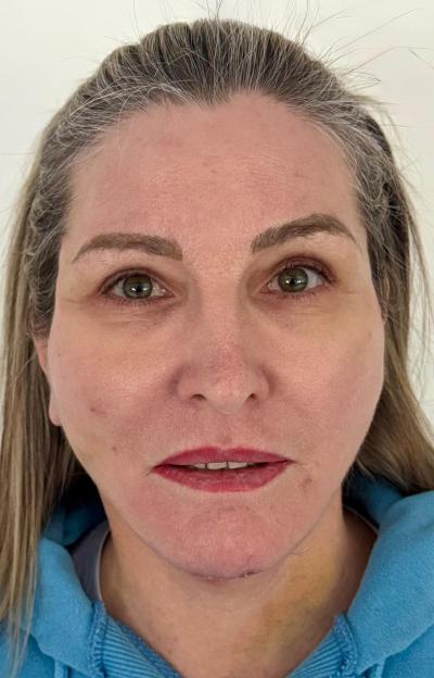 A close-up of Leigh Cobb’s face showing her facial and neck skin after her £4800 face and neck lift.
