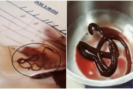 Chilling images of ‘world’s largest human parasite’ pulled ‘wriggling’ from man, 35, after simple cooking mistake
