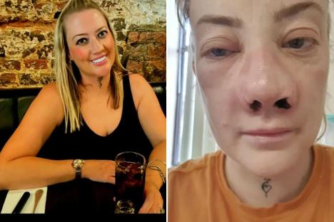 My face COLLAPSED after botched Turkey teeth op – it’s like broken glass smashed in my head & pain worse than childbirth