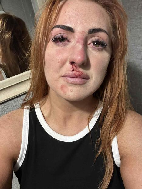 Mia Flynn with a bloodied nose and injuries on her face.