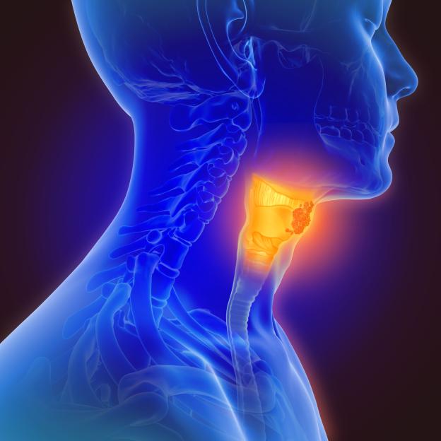 Illustration of throat cancer.