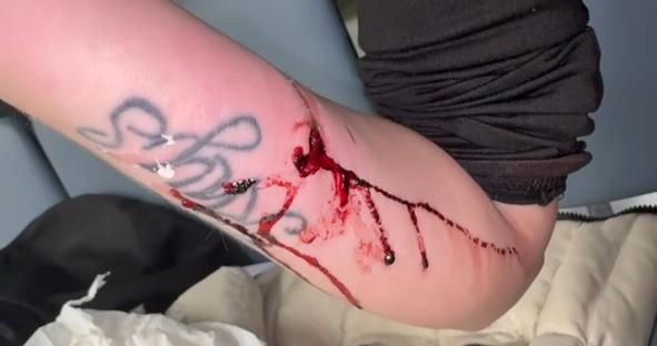 Bloody arm wound.