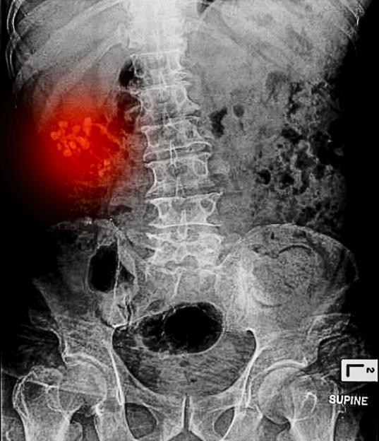 X-ray showing multiple kidney stones (red area) in a human abdomen.