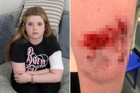 Schoolgirl, 11, has arm RIPPED OPEN in horror Bully dog attack leaving her covered in blood
