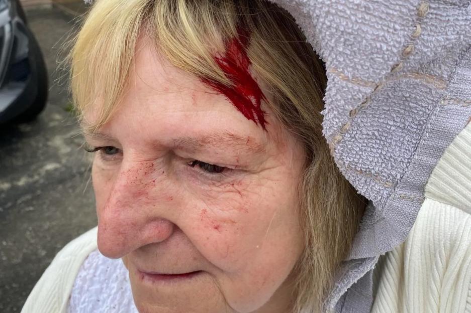 Woman left with bald patch & badly bleeding head after viscous seagull attack