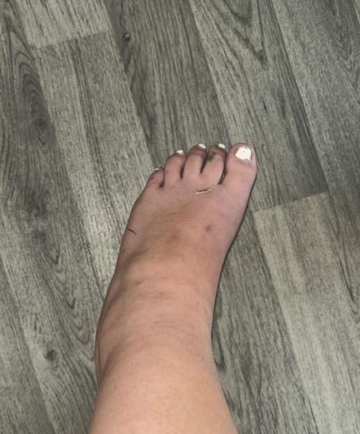 Pic from Kennedy News & Media (Pictured: 21-YEAR-OLD JESSICA FOSTER'S ANKLE SWOLLEN AFTER SLIPPING OVER IN 'OLD' CROCS.) A student is warning people not to wear 'old' Crocs - after slipping at a waterpark and being rushed to hospital with cracked ribs and internal bruising. Jessica Foster, from Grimsby in Lincolnshire, visited a waterpark with her partner Chad Munslow, 26, and his family, on July 19th to enjoy a day playing on the inflatables. But when the 21-year-old left the changing rooms in her size five white Crocs she says she slipped on wet grass, twisting her left foot and smashing her lower back into a steel step.DISCLAIMER: While Kennedy News and Media uses its best endeavours to establish the copyright and authenticity of all pictures supplied, it accepts no liability for any damage, loss or legal action caused by the use of images supplied and the publication of images is solely at your discretion. SEE KENNEDY NEWS COPY - 0161 697 4266