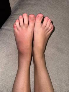 Swollen foot with redness and inflammation.