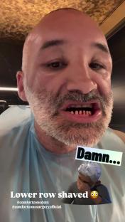 Close-up of a man with a bloody mouth and shaved lower teeth.