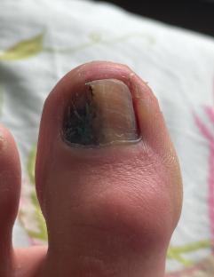 Close-up of a toe with a discolored and damaged toenail, a symptom of acral lentiginous melanoma.