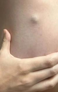 Close-up of a lump on a person's skin.
