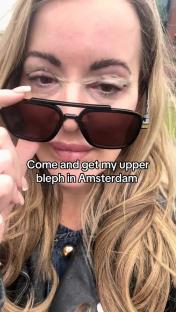 Woman with bandages on her eyelids after upper blepharoplasty in Amsterdam.