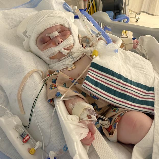 Baby Liam after surgery, with his head bandaged, tubes near his face, and an IV in his arm.