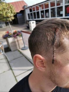 Man's head with a surgical scar.