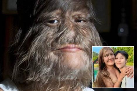 ‘World’s hairiest girl’ looks unrecognisable 25 years after photos stunned everyone & has even found love after split