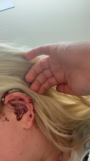 Bloody ear injury.