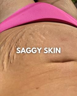 Sagging skin on a person's abdomen.