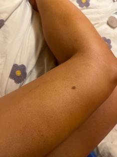 Close-up of a person's arm showing a mole.