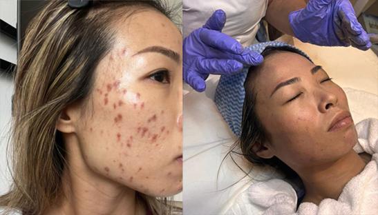 Before and after photos of acne treatment.