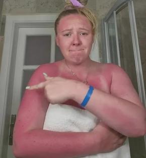 Woman showing severe sunburn after skipping sunscreen despite cloudy weather in Turkey.