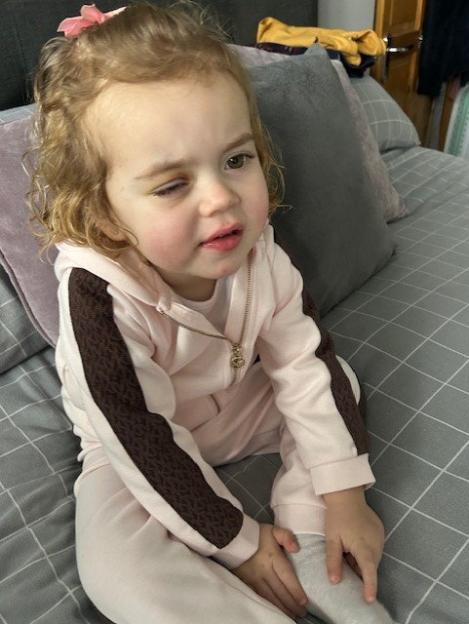 Young girl with swollen eye.