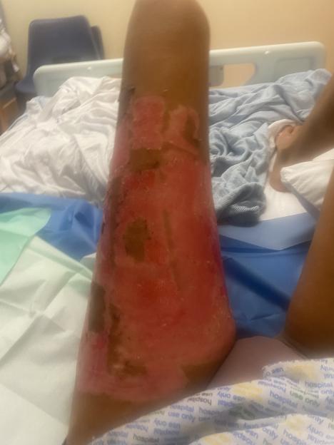 Severe leg injury with burns and abrasions.