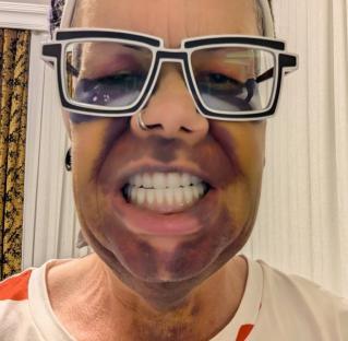 Close-up of a person's face with bruised skin and new dentures, wearing large glasses.