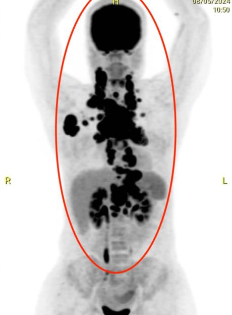 X-ray showing B-cell non-Hodgkin lymphoma.
