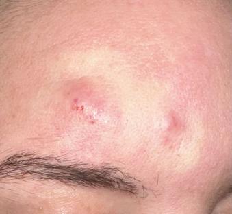Close-up of inflamed skin with oozing boils on a person's forehead.