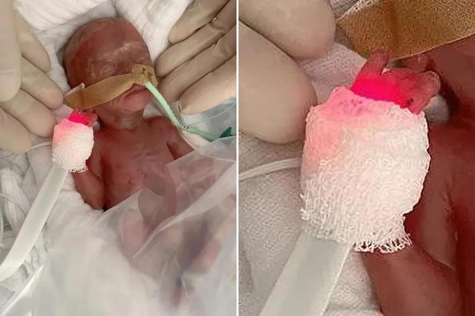 Miraculous Survival: Tiny Premature Baby Born 16 Weeks Early Weighs Just as Much as Two Slices of Bread