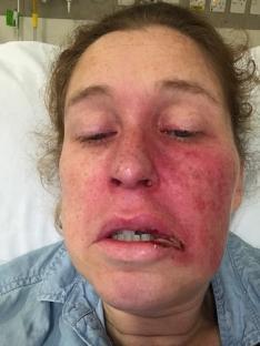Close-up photo of a woman's face showing severe facial swelling and a wound on her lip.