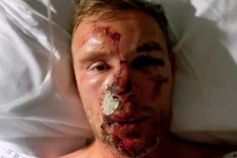 Freddie Flintoff reveals horror pics of Top Gear crash injuries for first time after ‘thinking face had been ripped off’