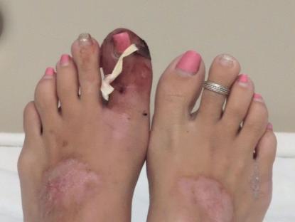 Close-up photo of a woman's feet, showing a severely infected ingrown toenail on her left big toe.