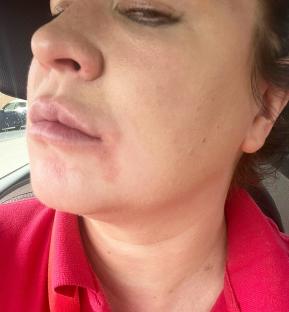 Close-up of a woman's face showing a skin reaction.