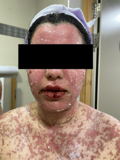 Person with Lyell's syndrome.
